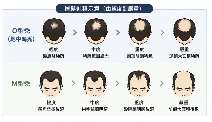 掉髮進程示意