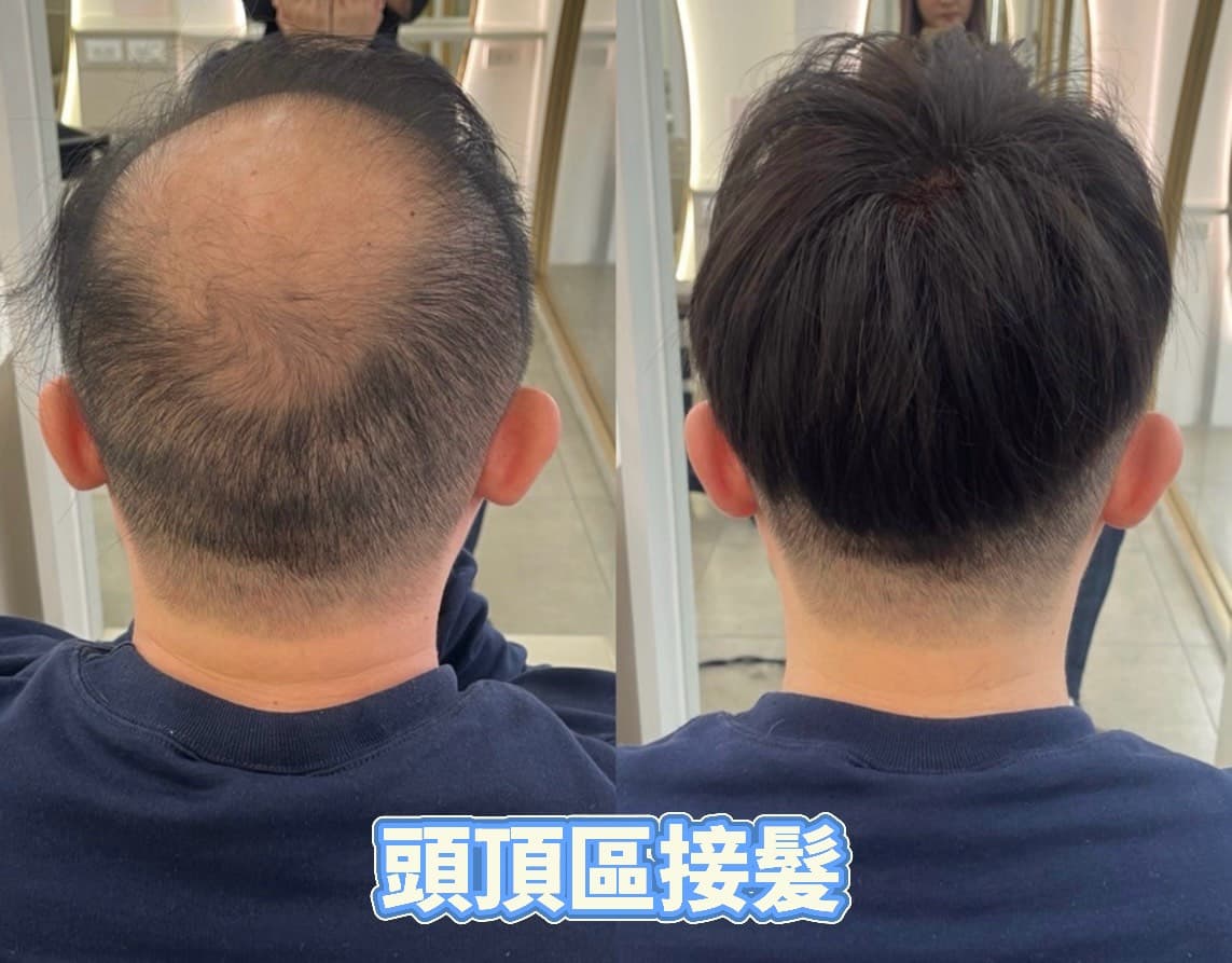 頭頂區接髮