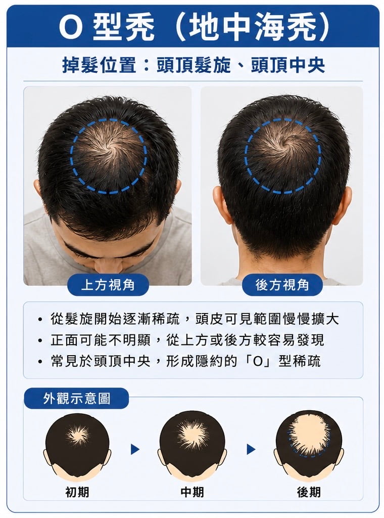 O型禿(地中海禿)