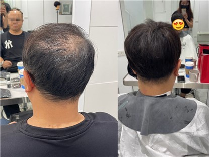 有掉髮 M 型禿也可以接髮