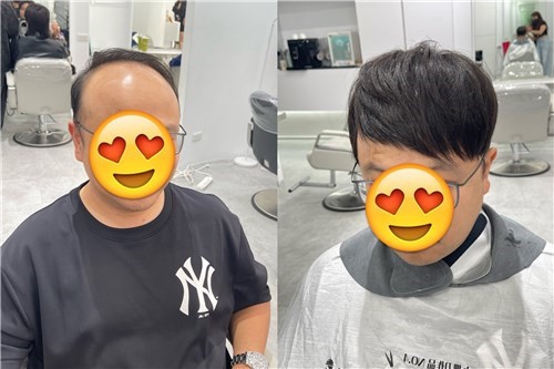 有掉髮 M 型禿也可以接嗎?