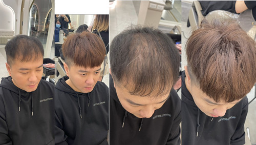 植髮前後對比圖