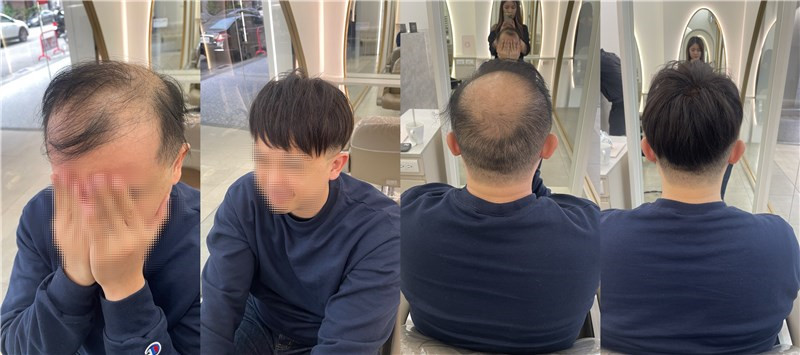 植髮前後對比圖3