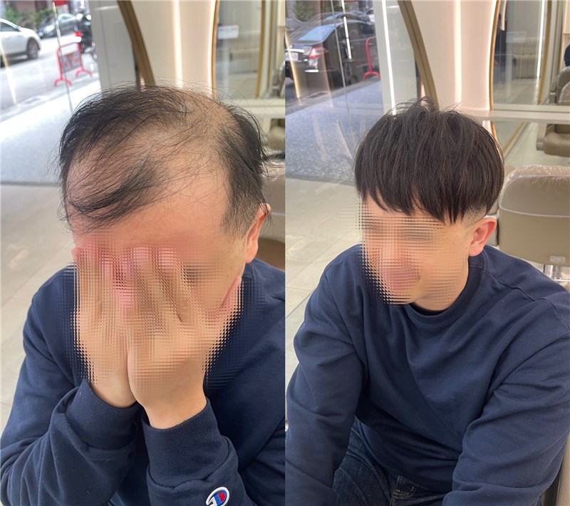 植髮前後對比