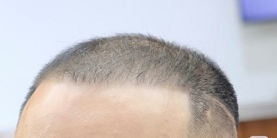 男生也能接髮？如何幫助改善髮量稀疏？