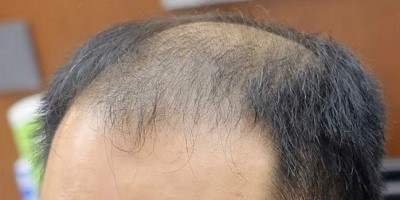 男生也能接髮？如何幫助改善髮量稀疏？