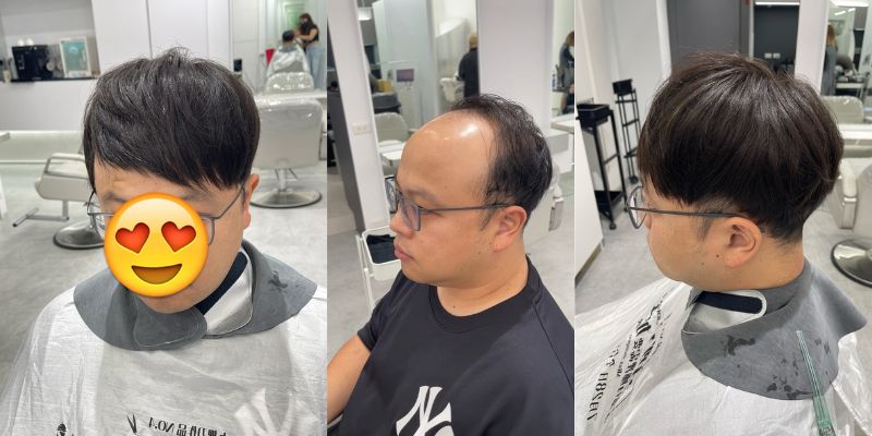 男生接髮常見的三種價格區間-地中海禿或大面積掉髮