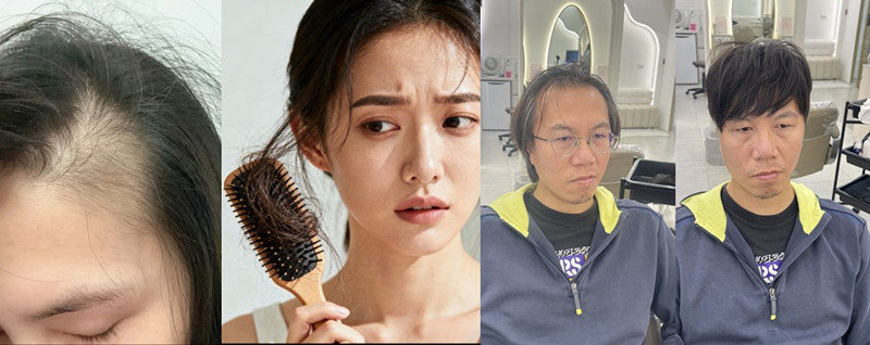 落髮困擾、植髮前後對比圖