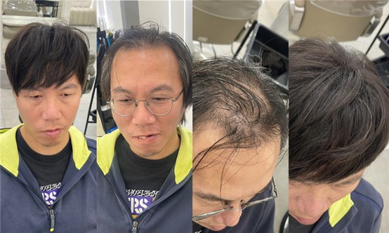 輕微M型禿建議以髮流與層次進行修飾