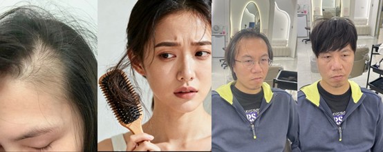 頭髮變少到什麼程度,需要尋求專業協助?