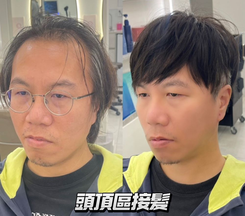 頭頂補髮片不適合怎麼辦？哪些情況可以評估接髮？
