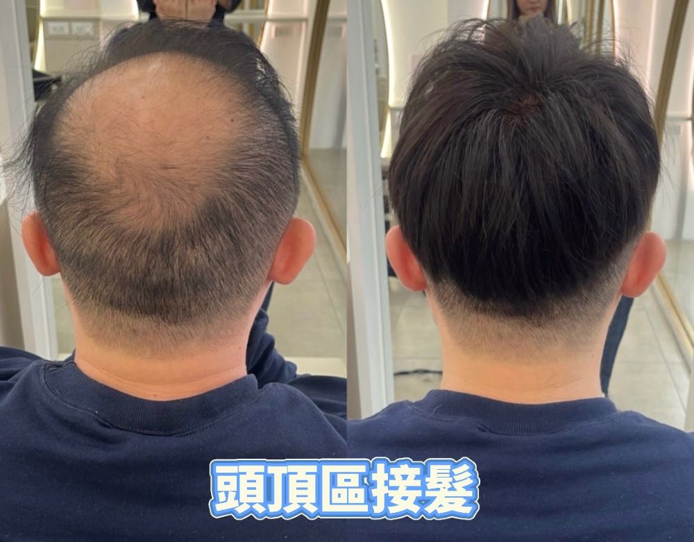 只有髮縫或髮旋明顯：頭頂補髮片