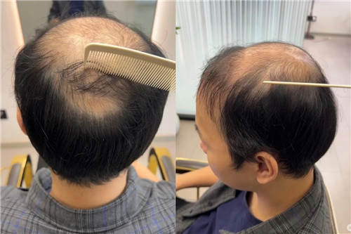 男生接髮和植髮有什麼不一樣？