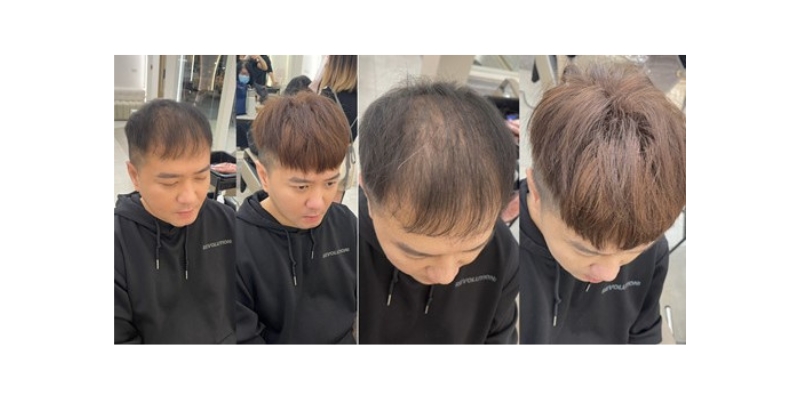 頭髮稀疏後天可改善的兩大重點：毛囊清潔與壓力管理