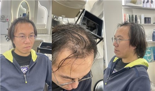 M型禿的常見特徵