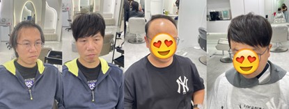 M型禿髮型只靠髮型設計就可以改善嗎？