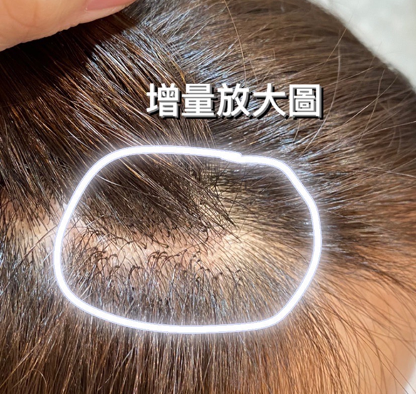 增量接髮