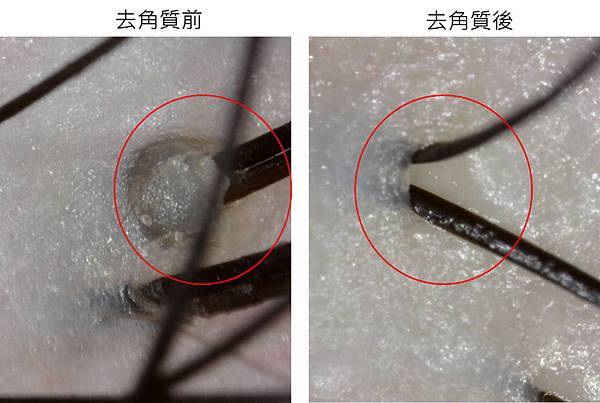 頭皮去角質前後對比圖