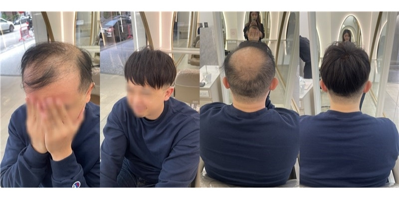 2026植髮價格大公開！以「根」還是以「株」計費？妮妮店長教你算懂植髮預算