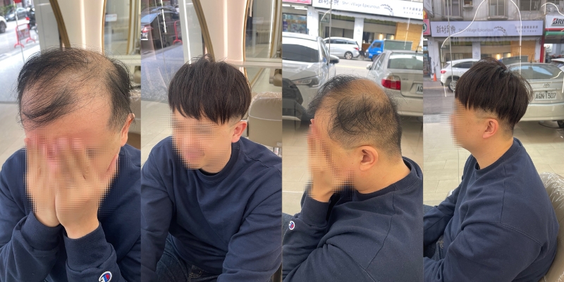 頭髮稀疏只能剪短？男生增髮密技與價格大公開 