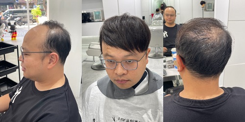 男生接髮｜帶你告別髮量稀疏，重獲濃密髮型 ！(1)