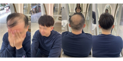 2026植髮價格大公開！以「根」還是以「株」計費？妮妮店長教你算懂植髮預算-1