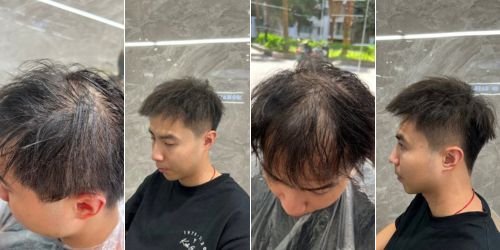 髮量不足適合頭頂補髮片嗎？帶你了解適用情況與挑選重點！