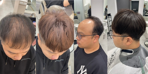 禿頭想做髮型只能戴假髮？了解禿頭適合的髮型與髮量增加技巧-1