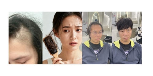 壓力大掉髮怎麼辦？男女都適用的增髮對策